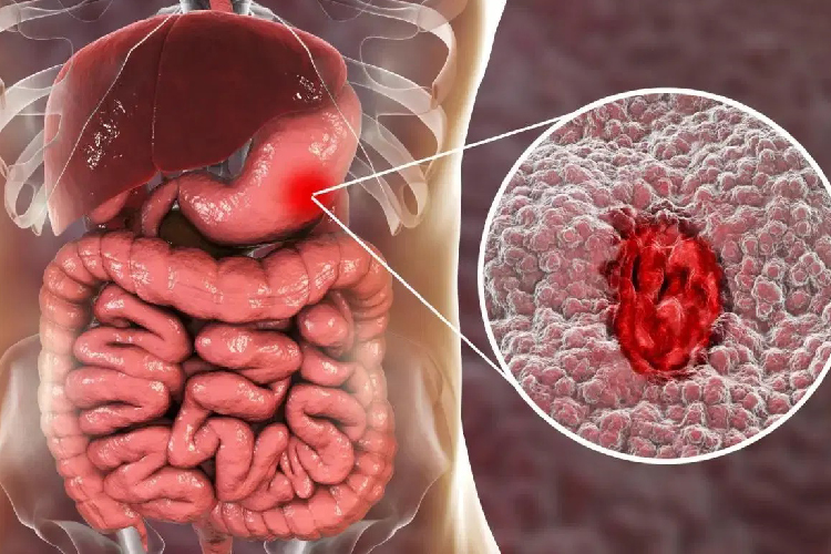 Gastrointestinal Cancer Surgery