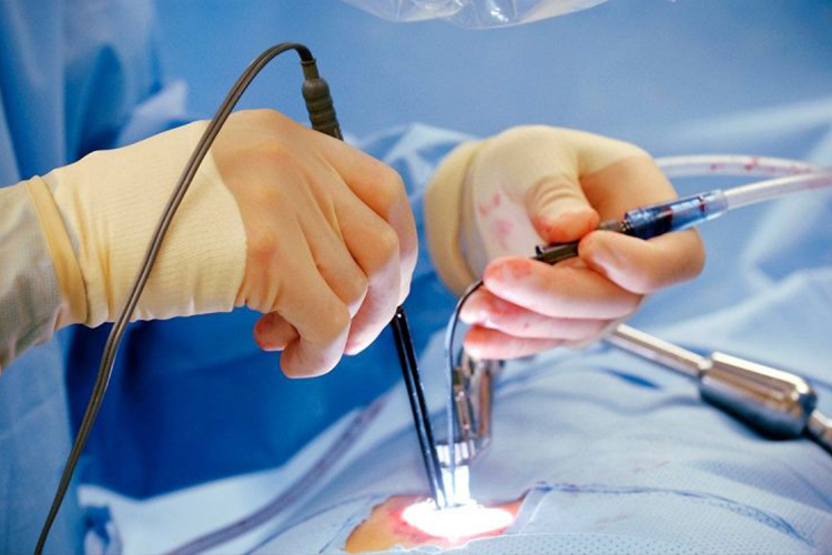 Laser Treatment for Hemorrhoids, Fistula, Fissure & Pilonidal Sinus