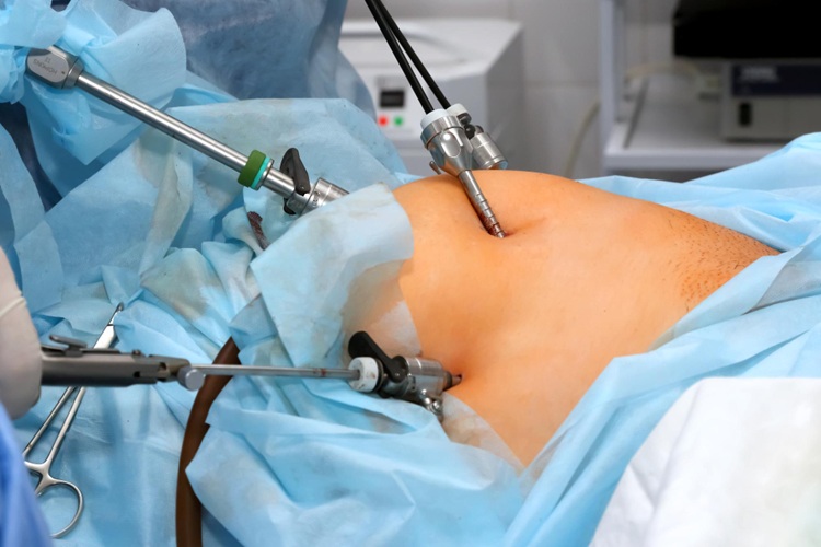 Why Laparoscopic Hernia Surgery Is Preferred Today